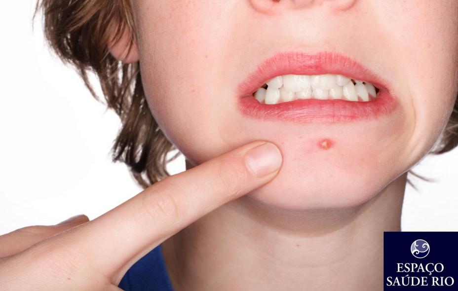 ACNE. Novo Guia De Cuidados Atualizado Pela Academia Americana De Dermatologia 1