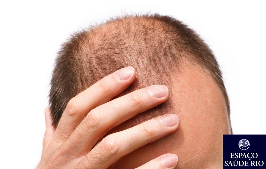Queda De Cabelo Masculina.Como Tratar 1