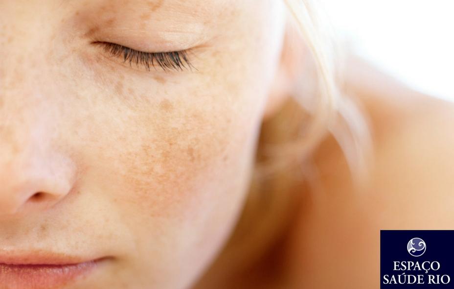 Como Tratar Melasma Combine Microagulhamento E Drug Delivery 1