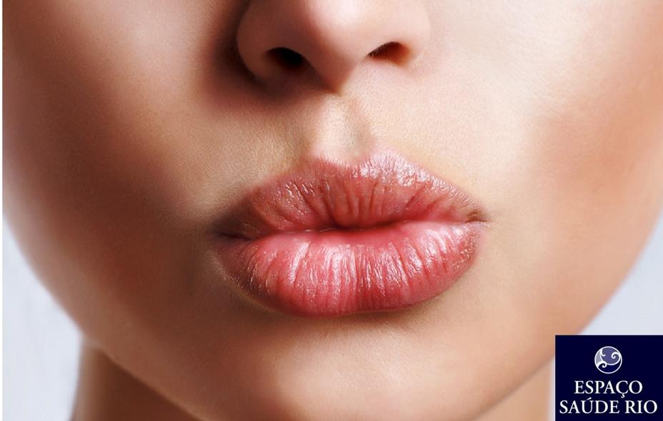 Preenchimento Labial Tudo O Que Você Precisa Saber 1