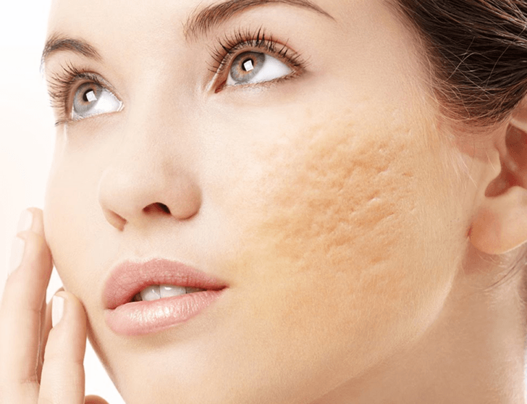 Manchas na pele-Acne|Dermatologia|Espaco Saude Rio