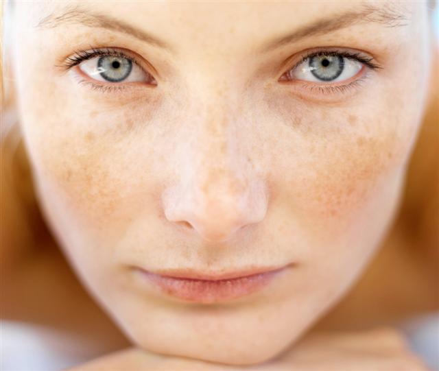dominio do melasma