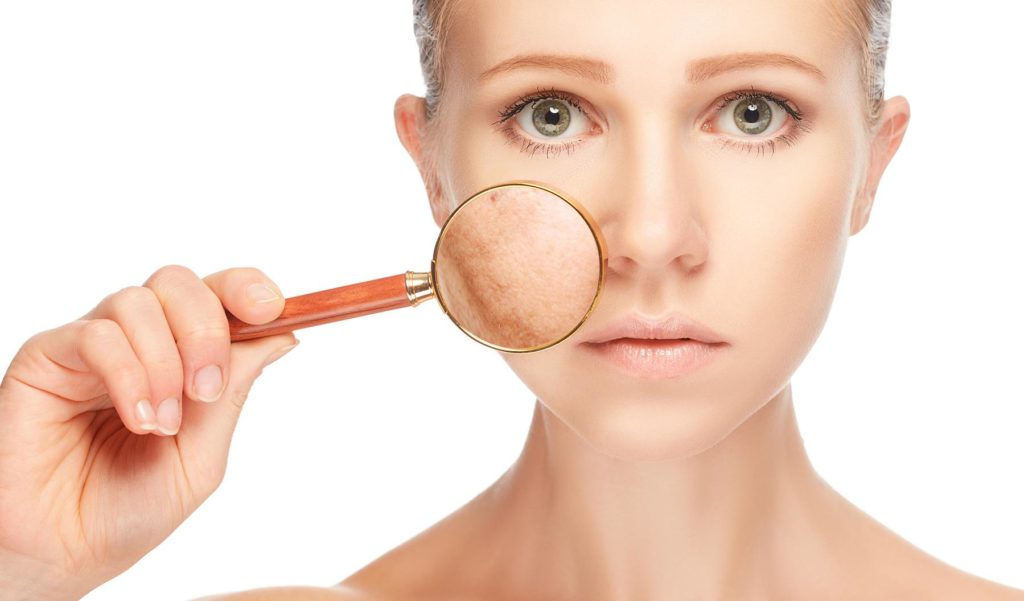 Melasma 1 1024x601