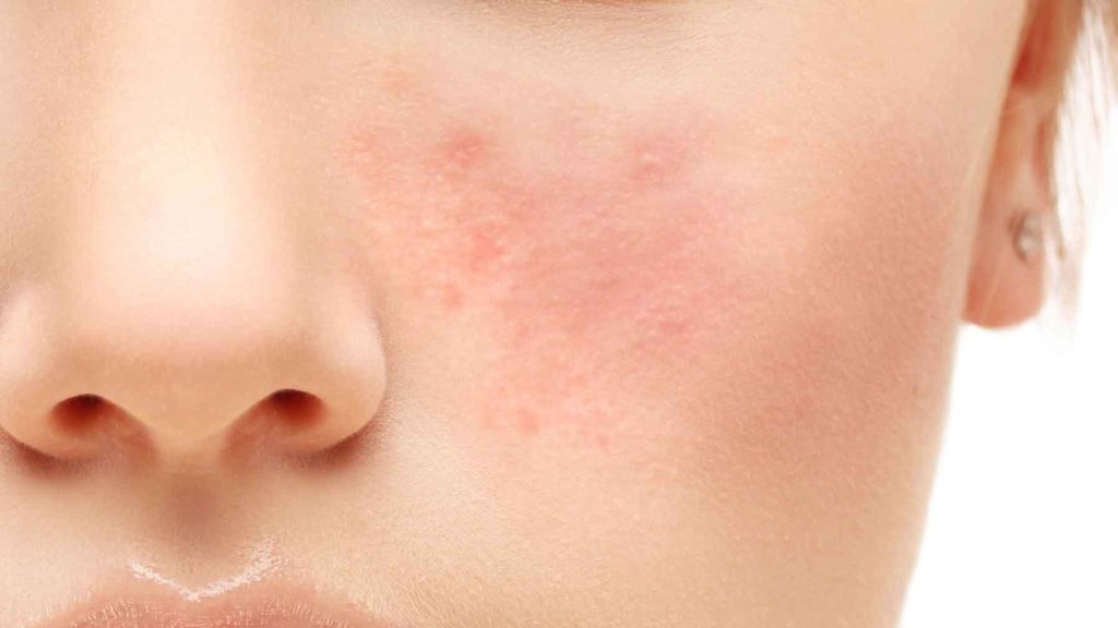 Rosacea 1 1024x576