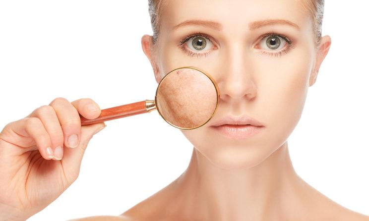 Melasma 2 744x446 1