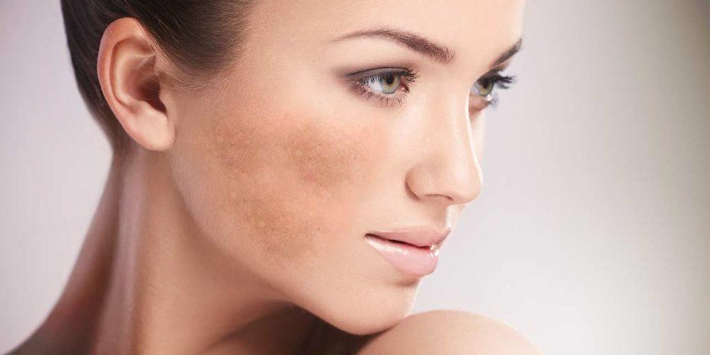 Melasma Tratamento 1280x640 1024x512 1