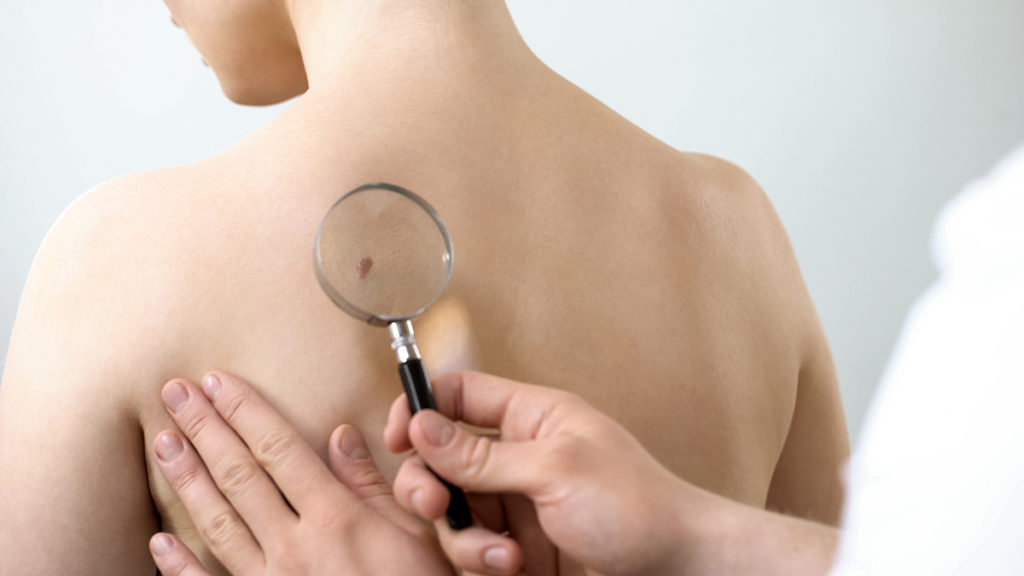 Canva Dermatologist Checking Mole Through Magnifying Glass Skin Cancer Prevention 1 1024x576