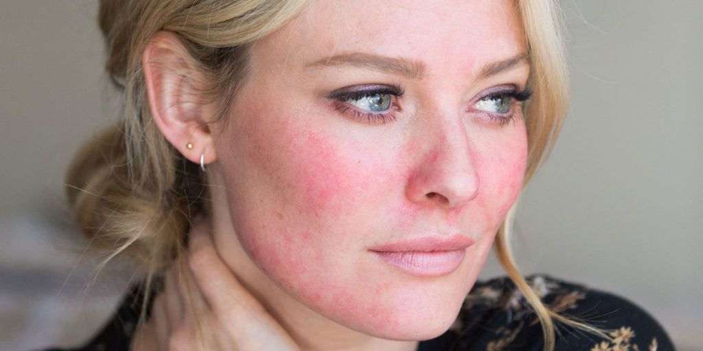 Rosacea Tratamentos 1
